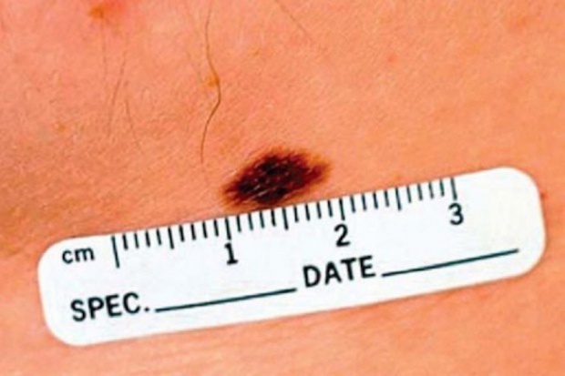 Dermatolog tłumaczy, że choroba częściej dotyka osoby starsze, gdyż na takiej skórze częściej pojawiają się różnego rodzaju plamy. Nadmierne opalanie sprzyja nowotworowemu rogowaceniu skóry