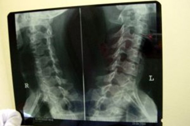 Październik: Światowe Dni Osteoporozy