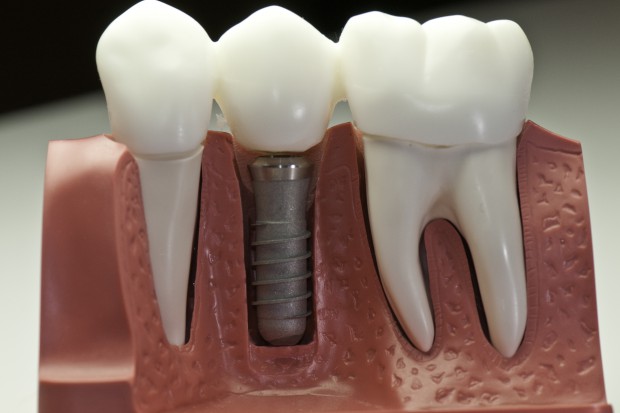 Naukowcy uważają, że wpływ na problemy z przyjęciem się implantu ma wpływ podawania leków z grupy SSRI (fot. Fotolia/PTWP) SSRI utrudniają osteointegrację implantów zębowych