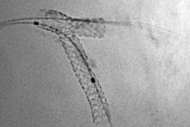 BVS po pewnym czasie są wchłaniane przez organizm Bioserbowalne stenty, czyli tabletki donaczyniowe
