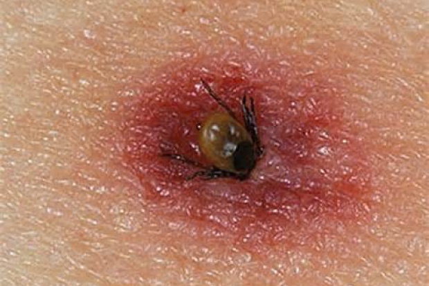 Kleszcze żyjące w Polsce są nadal groźne - twierdzą eksperci Szczepienie zaczyna być modne?