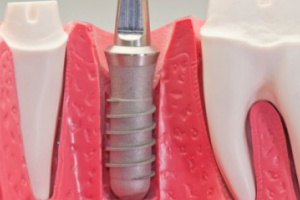 Beta - blokery sprzyjają wszczepianiu implantów