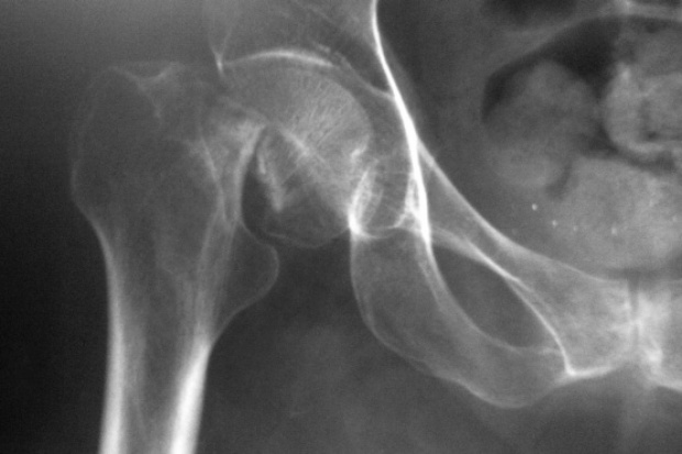 Czy popularne leki na osteoporozę zwiększają ryzyko mikropęknięć kości? Badania: bisfosfoniany zwiększają ryzyko mikropęknięć kości ?