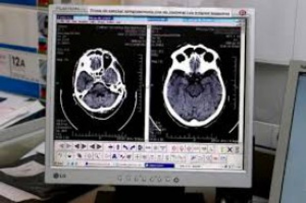 Jak oceniają autorzy, dzięki nowej metodzie można bezpieczniej usunąć większą cześć guza, przy mniejszej liczbie powikłań (Fot. Archiwum) Fluorescencyjny marker pozwala skuteczniej usunąć guza mózgu