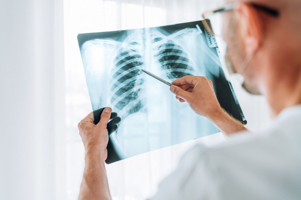 Minister zdrowia zdecyduje o refundacji atezolizumabu w raku płuca Fot. ShutterStock Data dodania: 19 grudnia 2022 Atezolizumab w raku drobnokomórkowym płuca. Co z wnioskiem refundacyjnym?